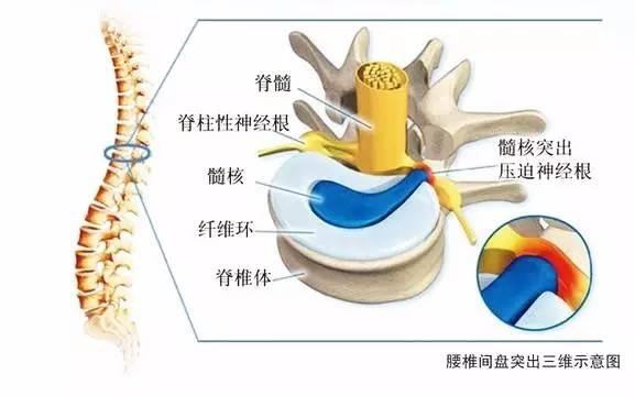 腰椎突出一般会有哪些身体不适的表现？申骨堂申一贴经验